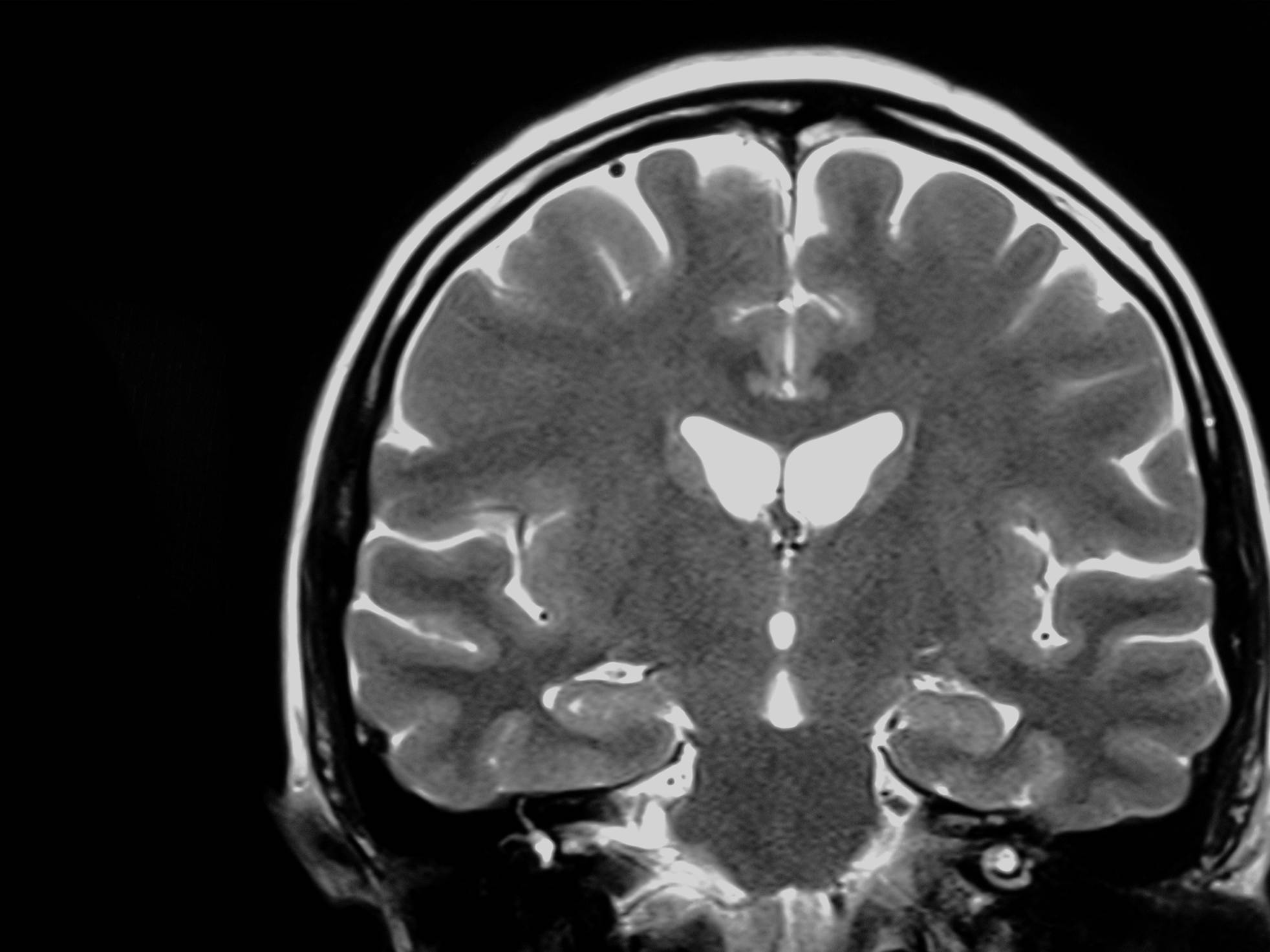 MRI of the brain