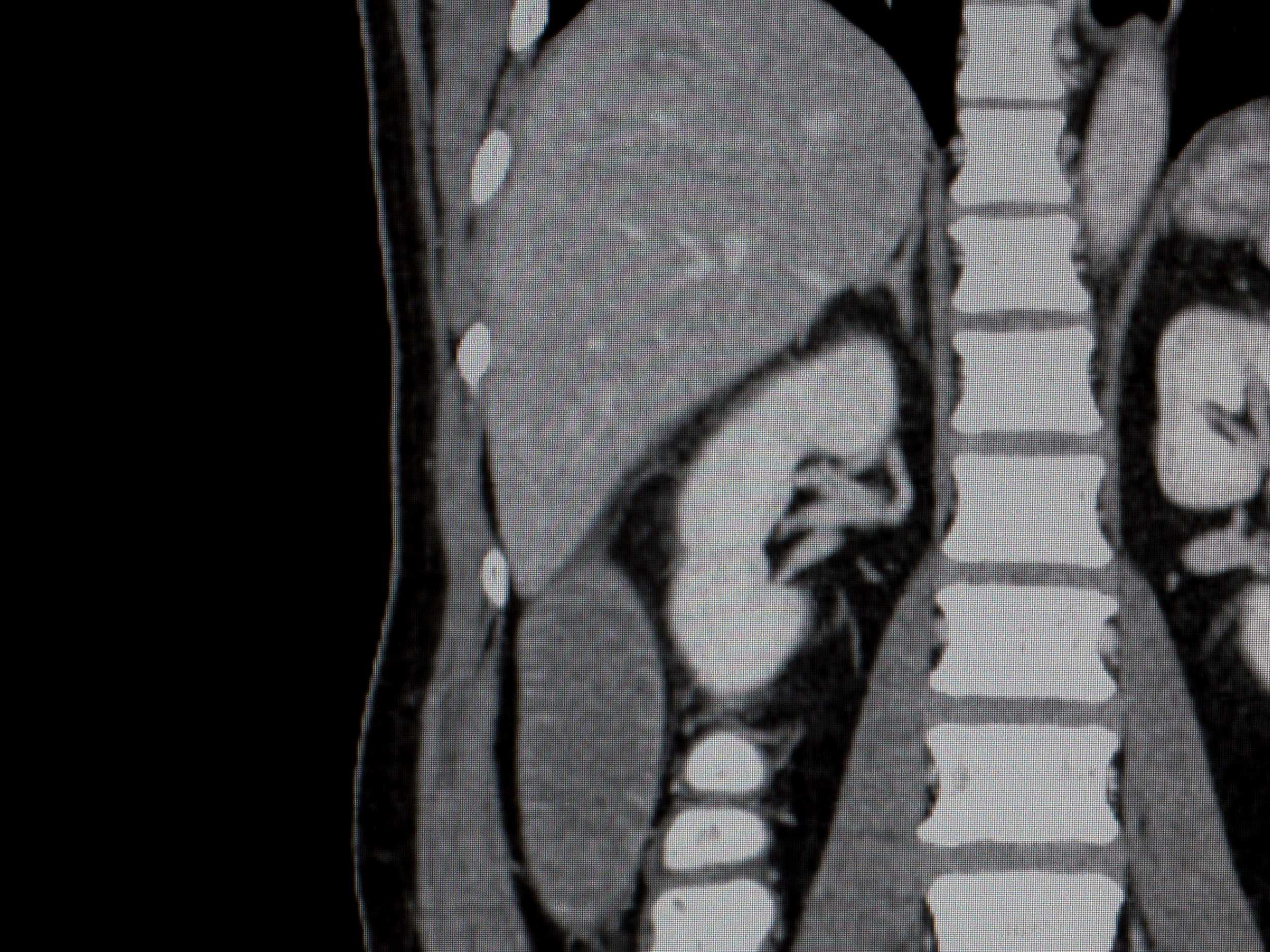 CT of abdomen