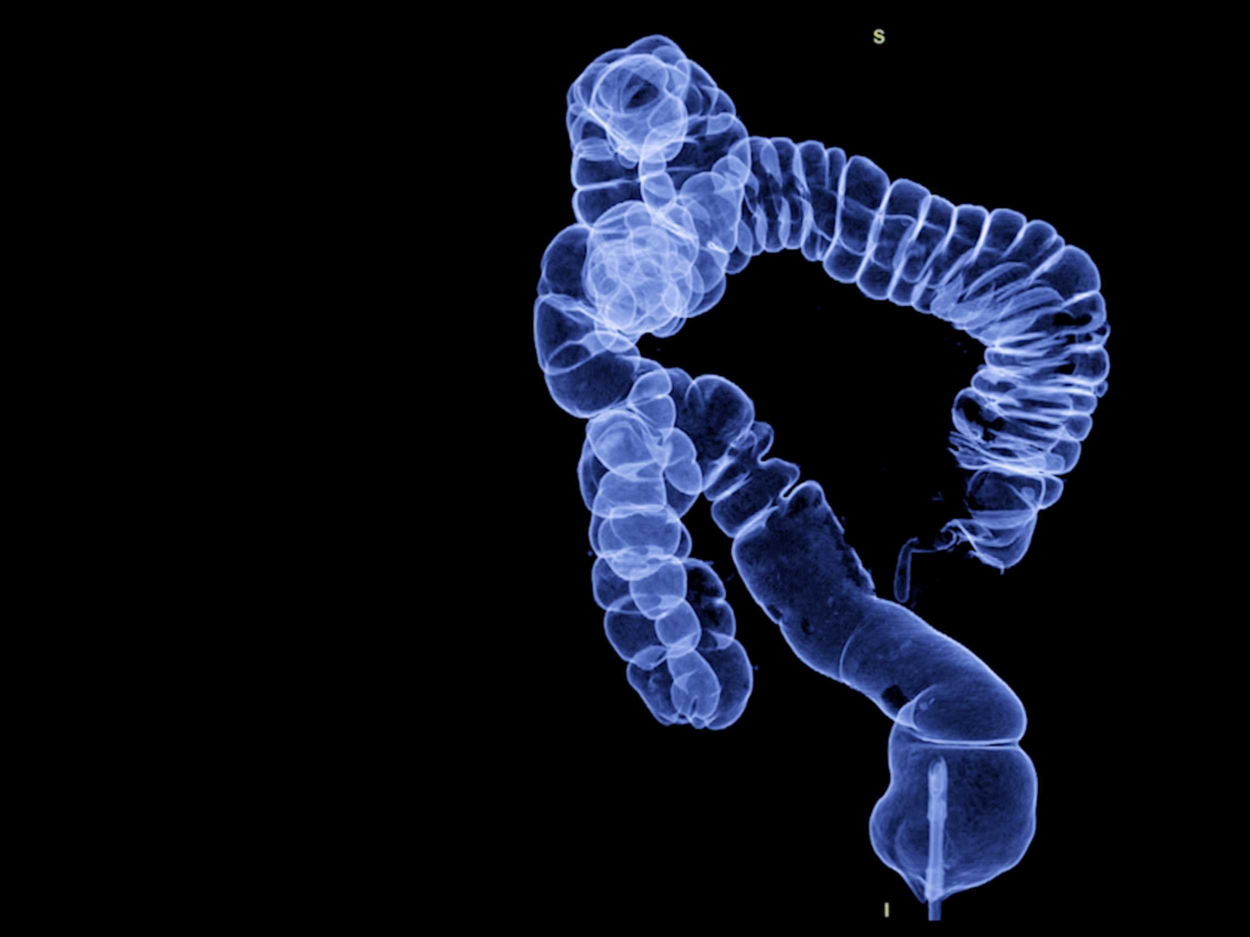 CT colonography