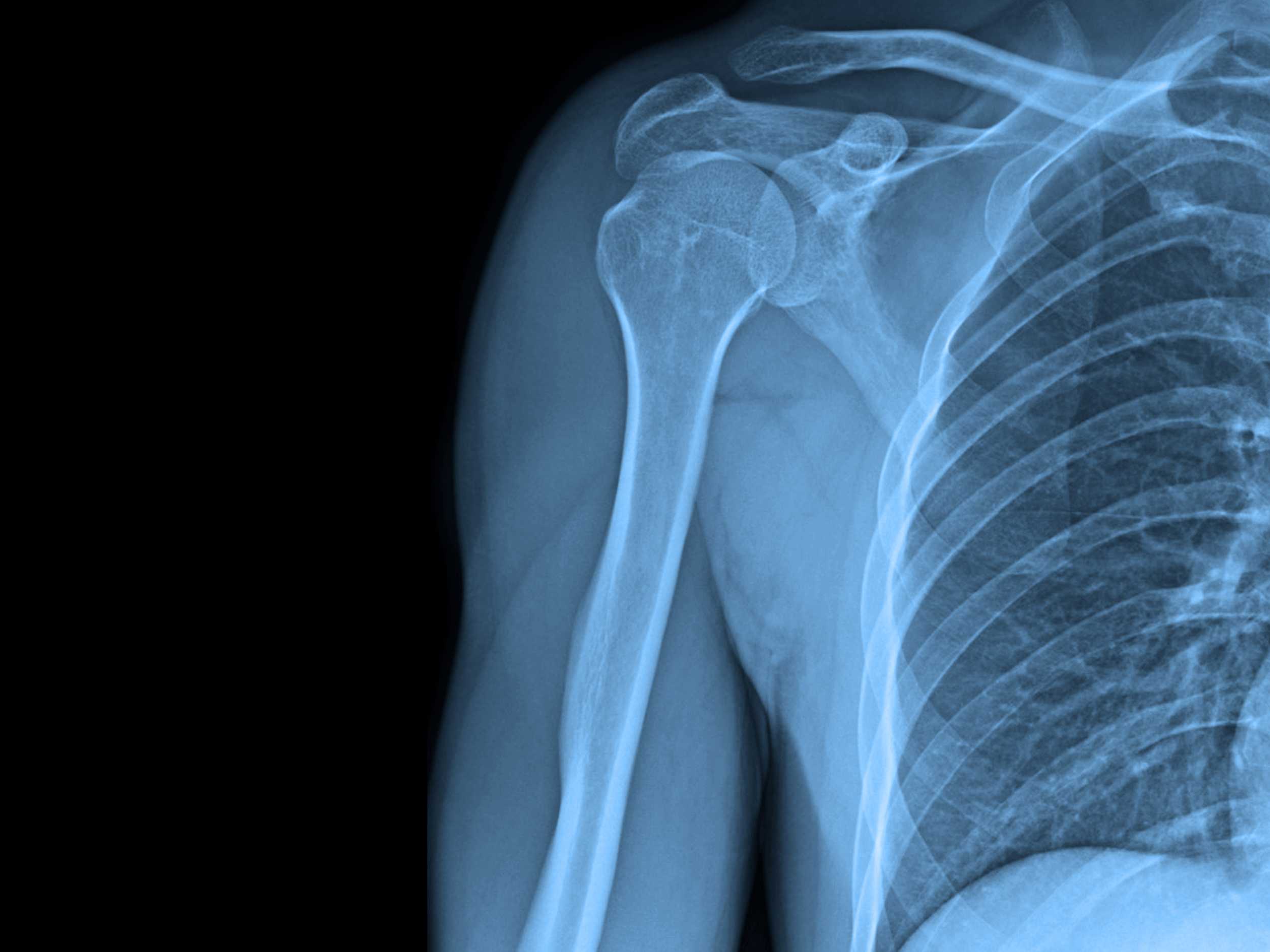X-ray of shoulder joint