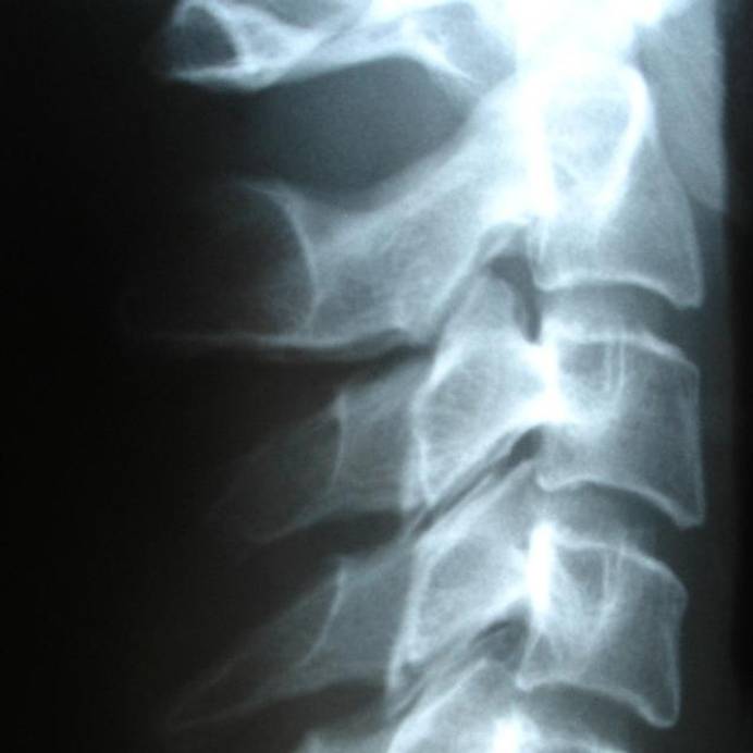 X-ray of spine