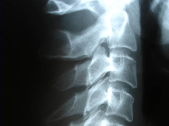 X-ray of spine