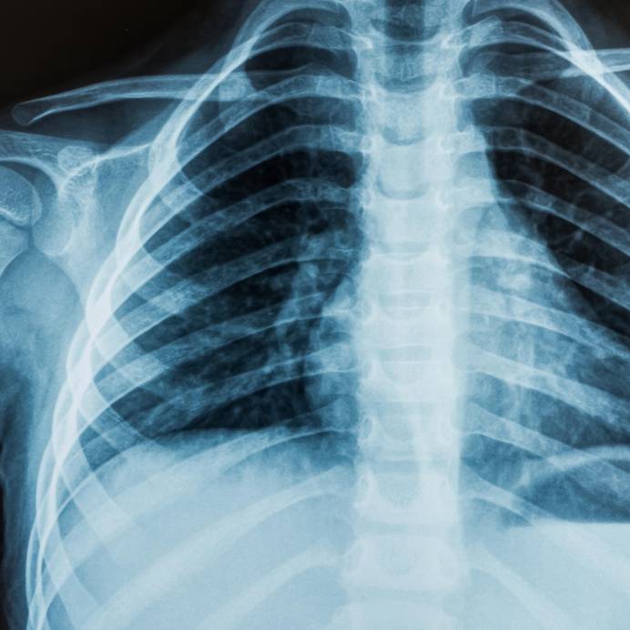 Close-up x-ray of bones