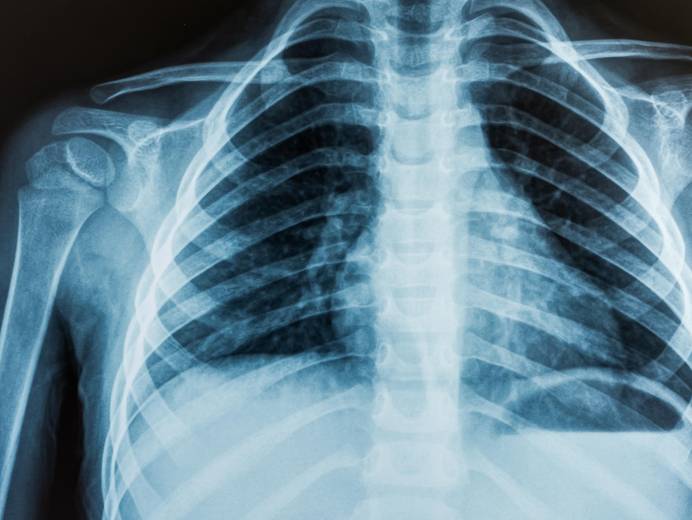 Close-up x-ray of bones