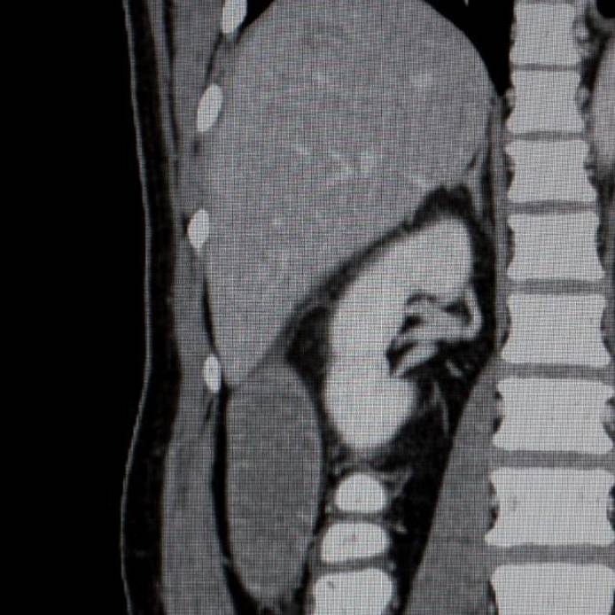 CT of abdomen