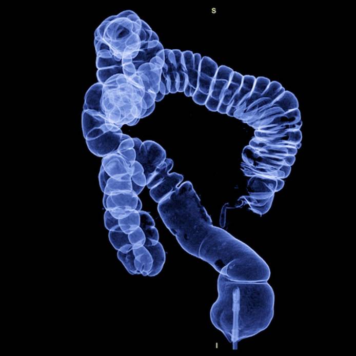 CT colonography