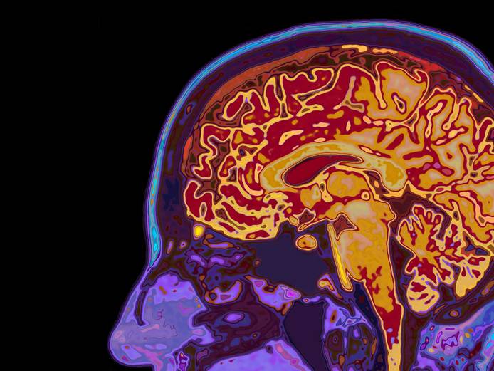 MRI scan of head